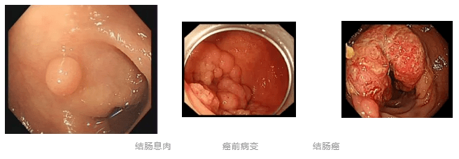 结肠息肉、癌前病变、结肠癌示意图