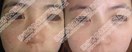 ȸ°ßÄÜÈ¥µôÂ𣬻¯×±Æ·Ö»ÄÜÕÚ覣¬²¢²»Äܳ¹µ×ÖκÃȸ°ß£¬ÒªÏëÖκÃȸ°ß£¬¾ÍÒ»¶¨ÒªÓÃËÄÁª½×Ìݼ¼Êõ£¬È¸°ßÖ»ÒªÓöԷ½·¨ÊÇÄÜÖκõ쬲»ÒªÌýÐÅ»¯×±Æ·µÈÍÁ°ì·¨£¬ÒÔÃâËðÉËÆ¤·ô£¬ÒýÆðÆäËûƤ·ô²¡¡£