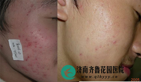 齐鲁花园医院皮肤科治疗痤疮红印第一个疗程后的效果