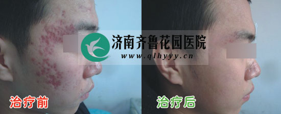 我院皮肤科治好的痤疮红印病例
