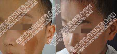 心形胎记是咖啡色的怎么治疗好得快,可以采用调Q激光治疗仪去除咖啡斑,此设备治疗效果非常好,并且没有副作用非常安全,能更好地清除咖啡斑,改善皮肤状况,达到理想的美容效果。