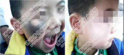 小孩脸上的太田痣治得好吗,双波长染料激光工作站比以前的激光更安全可靠,能够彻底清除太田痣,整个过程非常安全,用激光去除黑胎记太田痣虽然效果很好,但也要选择正规专业的医院。