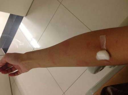 荨麻疹传染吗怎么治疗比较好,荨麻疹属于过敏性皮肤病,发病原因和饮食和生活习惯,环境有关系,不同荨麻疹患者的发病原因不一样,所选用的方法就不同,首先要找到荨麻疹的发病原因。