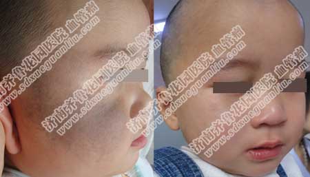 太田痣治疗需要多少钱,以往治疗太田痣的方法效果都不如激光好,双波长染料激光工作站联合药物治疗太田痣黑胎记的过程非常安全,疗效也是以往医疗设备和方法所达不到的。