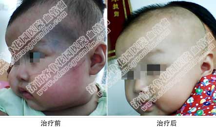 太田痣哪里治得好,太田痣一是影响孩子的外貌,二是对孩子的心理造成伤害,双波长染料激光工作站联合我院其他先进技术协同治疗太田痣,不但治疗更彻底,还完全避免了反复发作等弊端。