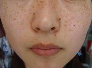 脸上出现好多褐色小斑点应该怎么办,要正确看待脸上长雀斑,选择合适的方法治疗及护理,不要因为脸上长小斑点而产生更大的心理压力,不要乱用祛斑产品,以免引起色素沉着,加重雀斑病情。