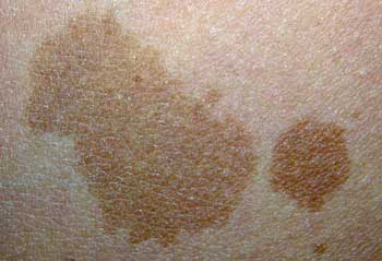 祛咖啡斑需要多少钱,目前祛咖啡斑最好方法就是调Q激光设备,联合药物综合治疗,能更快更好的祛咖啡斑,祛咖啡斑需要多少钱,是和治疗次数,选用的什么方法有关。