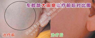 ×óÁ³²¿Ì«ÌïðëÖÎÁÆÇ°ºó¶Ô±ÈͼƬ