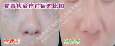 Á³²¿ºÖÇàðëÖÎÁÆÇ°ºó¶Ô±ÈͼƬ