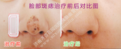 Á³²¿±Ç×ӱǼâÉϵİßðëÖÎÁÆÇ°ºó¶Ô±ÈͼƬ