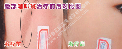 Á³²¿¿§·È°ßÖÎÁÆÇ°ºó¶Ô±ÈͼƬ