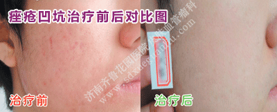 Á³ÉϵÄðî´¯°¼¿ÓÖÎÁÆÇ°ºó¶Ô±ÈͼƬ