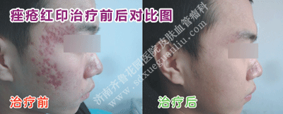 Á³²¿µÄðî´¯ºìÓ¡ÖÎÁÆÇ°ºó¶Ô±ÈͼƬ