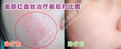 Ãæ²¿ºìѪ˿ÖÎÁÆÇ°ºó¶Ô±ÈͼƬ