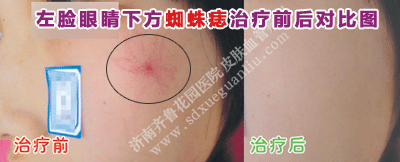 ×óÁ³ÑÛ¾¦Ï·½Ö©ÖëðëÖÎÁÆÇ°ºó¶Ô±ÈͼƬ