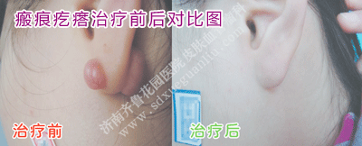 ×ó¶ú´¹²¿Î»ñ£ºÛ¸í´ñÖÎÁÆÇ°ºó¶Ô±ÈͼƬ