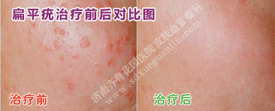 Á³ÉÏµÄ±âÆ½ðàÖÎÁÆÇ°ºó¶Ô±ÈͼƬ