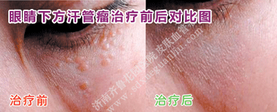 ÑÛ¾¦Ï·½º¹¹ÜÁöÖÎÁÆÇ°ºó¶Ô±ÈͼƬ