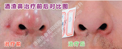 ¾ÆÔü±ÇµÄÖÎÁÆÇ°ºó¶Ô±ÈͼƬ