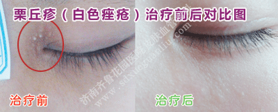 ÀõÇðÕî°×É«ðî´¯µÄÖÎÁÆÇ°ºó¶Ô±ÈͼƬ