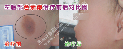 ×óÁ³²¿É«ËØðëµÄÖÎÁÆÇ°ºó¶Ô±ÈͼƬ