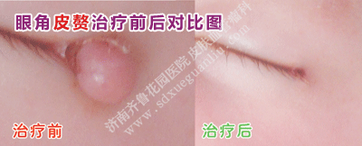 ÑÛ½ÇÆ¤×¸µÄÖÎÁÆÇ°ºó¶Ô±ÈͼƬ