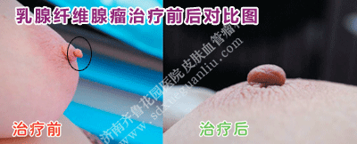 ÈéÏÙÏËάÏÙÁöÖÎÁÆÇ°ºó¶Ô±ÈͼƬ