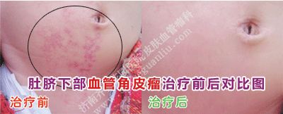 ¶ÇÆêϲ¿Ñª¹Ü½ÇƤÁöÖÎÁÆÇ°ºó¶Ô±ÈͼƬ