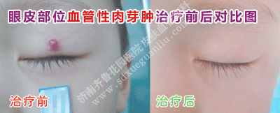 ÑÛÆ¤²¿Î»Ñª¹ÜÐÔÈâÑ¿Ö×ÖÎÁÆÇ°ºó¶Ô±ÈͼƬ