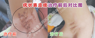 ðà×´±íƤðëµÄÖÎÁÆÇ°ºó¶Ô±ÈͼƬ