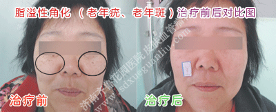 Ö¬ÒçÐԽǻ¯ÀÏÄêðàÀÏÄê°ßµÄÖÎÁÆÇ°ºó¶Ô±ÈͼƬ