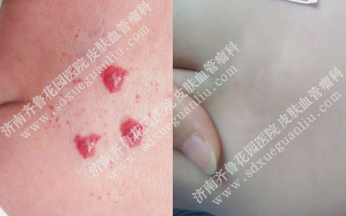屁股上的血管瘤危险吗 臀部血管瘤危险吗