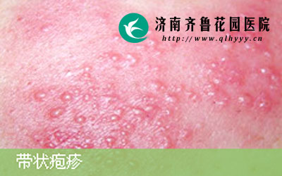 近日,济南齐鲁花园医院皮肤科门诊接诊了不少带状疱疹患者,皮肤科专家张珺主任介绍,长期处于疲劳过度的中青年人和身体免疫力底下的老年人易患带状疱疹,那得了带状疱疹应该怎么办。
