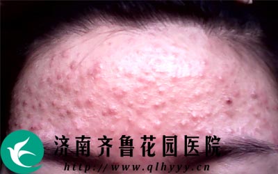 毛囊炎好发于头部面部四肢等部位,是由化脓性球菌侵犯毛囊口周围而导致的。