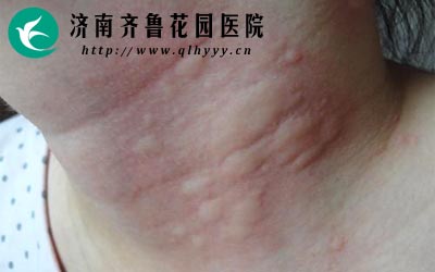 荨麻疹平时要注意什么,荨麻疹患者平时要注意卫生习惯养成一个良好生活习惯。