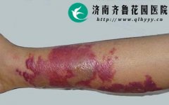 丹毒的症状表现和类型有哪些_济南齐鲁花园医院
