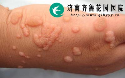 扁平疣具有极大的传染性会传染给周围的人,目前治疗扁平疣最好的方法就是四联阶梯技术。