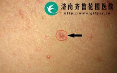 ɽ��ʡ�Ͳ����ļ�ҽԺ����ë���׺�