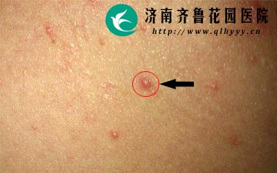 毛囊炎性质较顽固应选择专业的医院治疗。