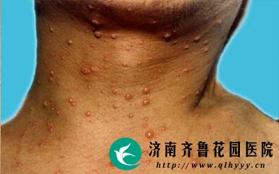 治疗带状疱疹需要多少钱,要看它的病情轻重情况和选择的治疗方法。