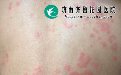 荨麻疹是很多见的一种过敏性皮肤病,剧烈瘙痒则是荨麻疹发病最主要的症状表现,这也是很多荨麻疹患者无法忍受的,那么,荨麻疹患者该怎么减轻瘙痒感呢。