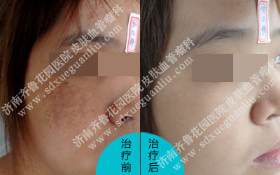 褐青痣好生长在颧部,额头部,颞部及下眼睑处,皮损颜色为黑褐色,青褐色或灰褐色的斑疹,而赵女士颧骨处长了褐青痣已好几年了,特意来我院咨询褐青痣可以去除掉吗。