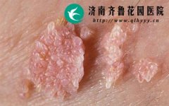 ʲôԭ��ᵼ�¼���ʪ�ิ��