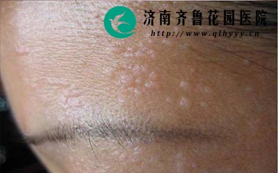 扁平疣危害较大不仅影响美观还给生活学习带来影响。