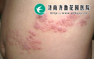 在春秋季节我们经常见到很多带状疱疹患者,尤其是成年人占大多数,那么,带状疱疹的起因是什么呢,带状疱疹的危害又有哪些呢。
