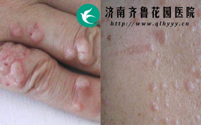 扁平疣是一种病毒性皮肤病难以自愈。