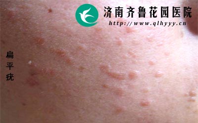 扁平疣患者在治疗过程中要注意防晒不要私自乱用药物。