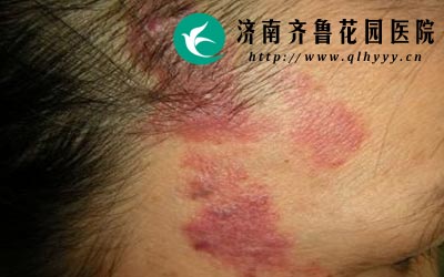 抵抗力低老年人和孩子孕妇等容易感染带状疱疹病毒。