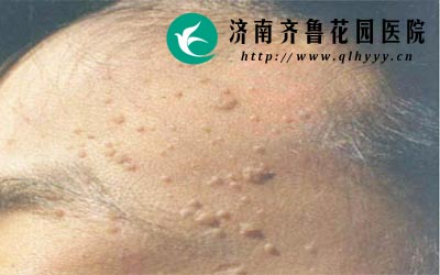 扁平疣患者应每天保证睡眠在7个小时以上。