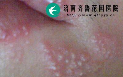 嘴唇上起了疱疹要保持患处清爽。